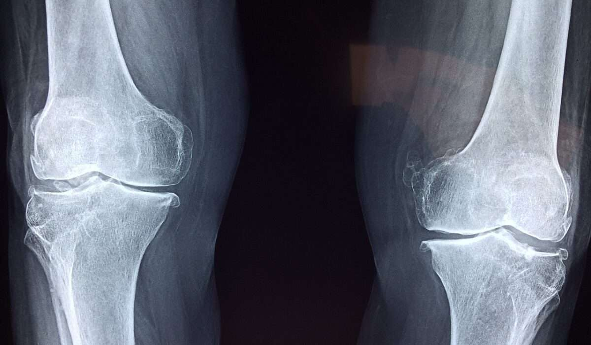 knee, x-ray, medical, anatomy, skeleton, bone, orthopedic, joint, health, injury, patient, cartilage, treatment, hospital, therapist, illness, disease, blue health, blue hospital, blue medical, knee, knee, knee, x-ray, bone, bone, bone, bone, bone, joint, joint, injury, injury